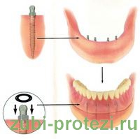 шаровидное крепление зубных имплантов