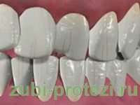 показания к протезированию зубов