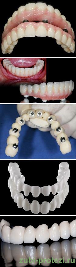 виды зубных мостов на имплантах