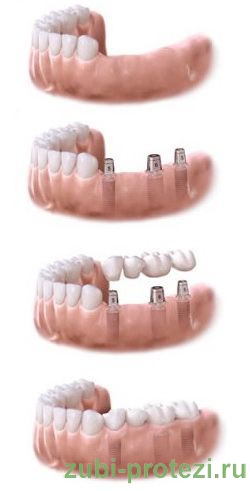 этапы установки зубного моста на имплантах