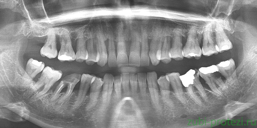 Как выглядит пародонтоз на снимке
