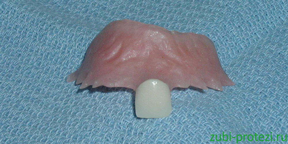 Сколько служат зубные протезы на один зуб