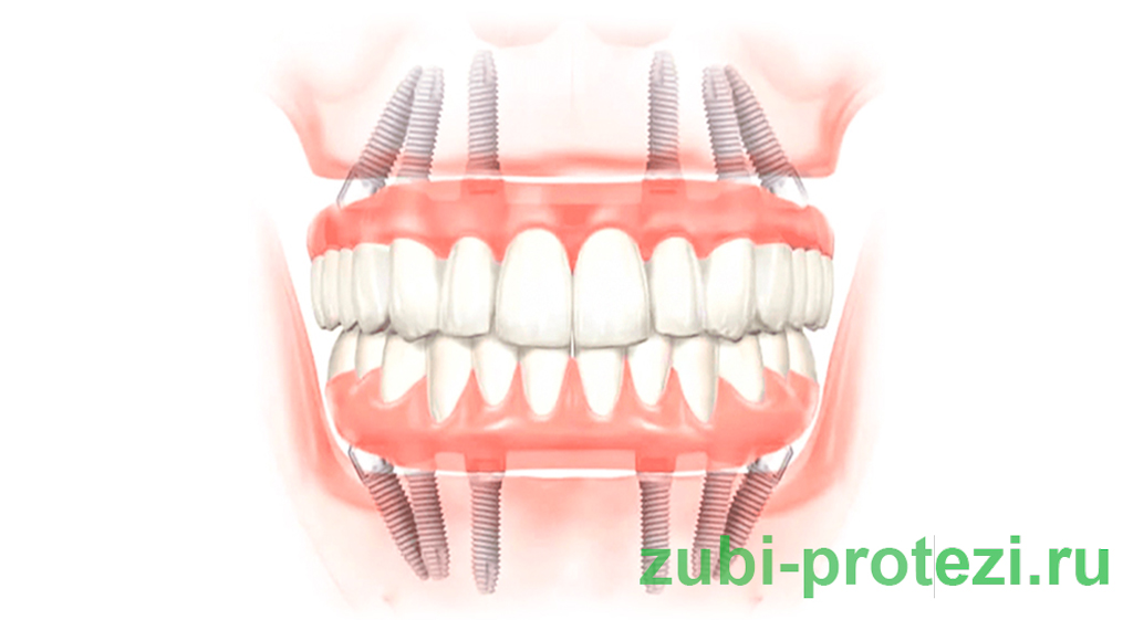 All-on-6 имплантация