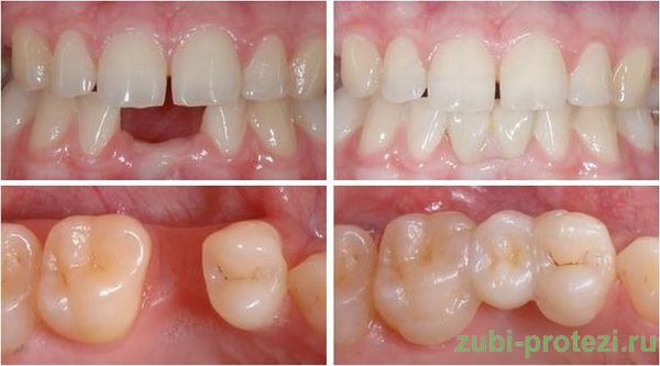 адгезивно-мостовидные протезы фото до и после