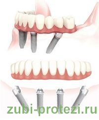 протезирование зубов all-on-4