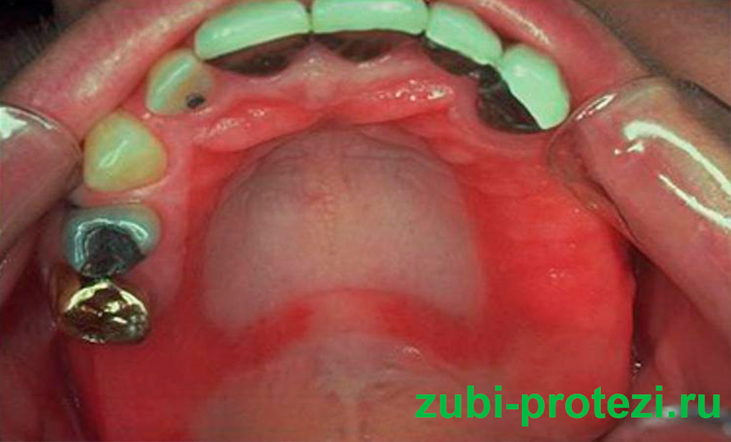 аллергия на зубной протез