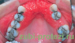 аллергия на зубной протез