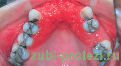 аллергия на материалы зубного протеза