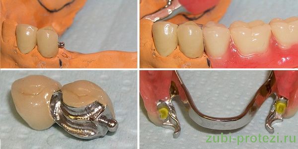 протезирование зубов на микрозамках