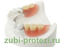 частично съемные зубные протезы