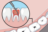 что такое депульпация зуба