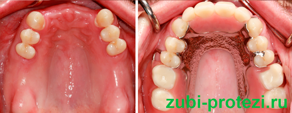 до и после протезирования