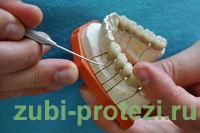 этапы установки зубных коронок