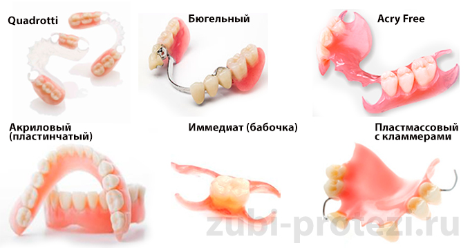виды съемного протезирования зубов