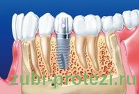 имплантация или протезирование зубов