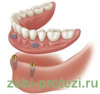 Несъемные зубные протезы на имплантах