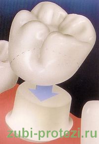 одиночная зубная коронка