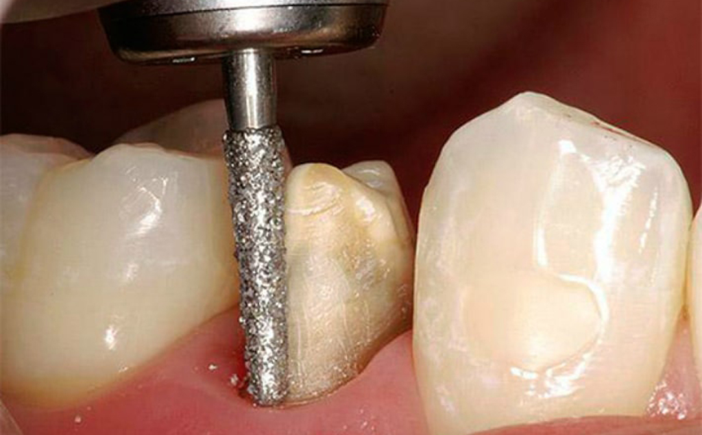 подготовка зуба