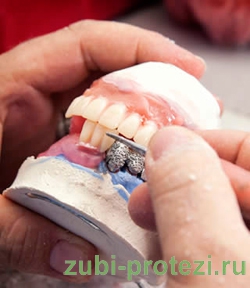 ошибка зубного техника - одна из причин осложнения после протезирования
