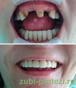 отсутствие нескольких зубов - показания к протезированию зубов