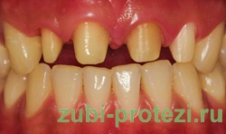 показания к протезированию зубов
