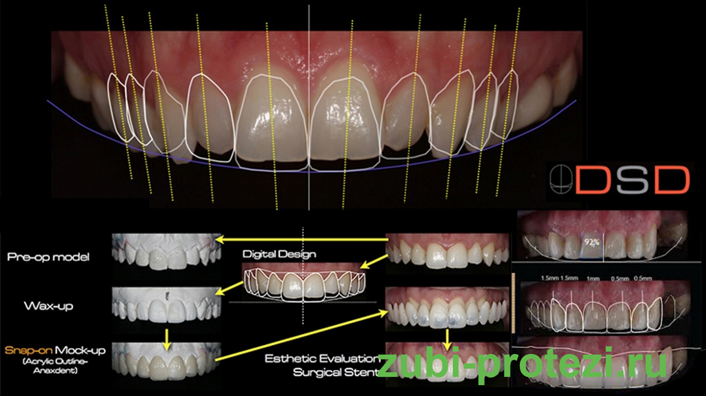 Digital Smile Design