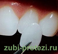 керамические виниры на зубы