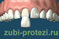 виниры при протезировании передних зубов