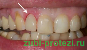 воспаление от коронки