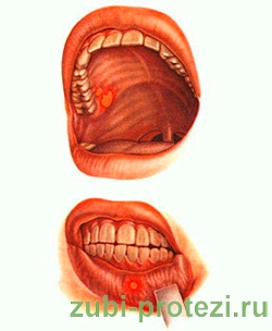 острые заболевания полости рта