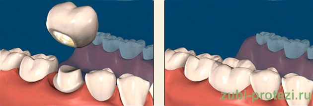 постоянное протезирование зубов