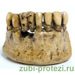 крепление зубных протезов в средние века