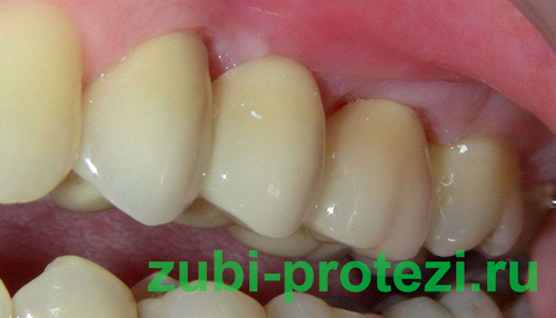 zubnoy protez 2