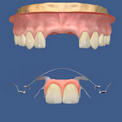 Бюгельное протезирование передних зубов