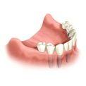 Имплантация - альтернатива зубному мосту