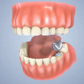 Как устанавливаются зубные коронки
