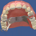 Восстановление зубного ряда бюгельными протезами