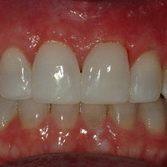 фото протезирование зубов
