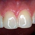 Травма переднего зуба и его восстановление керамикой