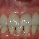 фото после протезирования зубов