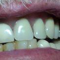 Частичный нейлоновый протез для восстановления 5 зубов