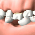 Один отсутствующий зуб - негативные последствия