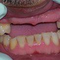 Полиуретановый протез на передних зубах  до и после