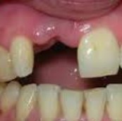 протезы на передние зубы