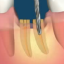 Реставрация полуразрушенного зуба коронками