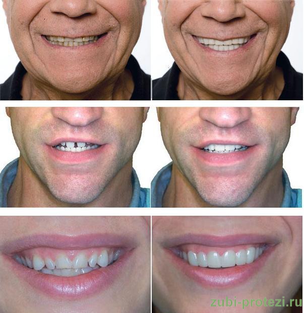 Snap-ON smile фото примеры протезирования до и после