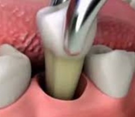протезы после удаления зуба