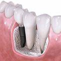 Имплантация зубов - протезы на имлантах