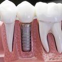 Зубные коронки на имплантах